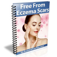 Free From Eczema Scars - Eczema Free You